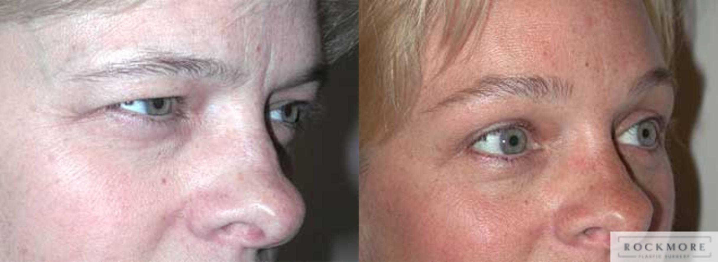 Before & After Eyelid Surgery Case 53 View #2 View in Albany & Latham, New York