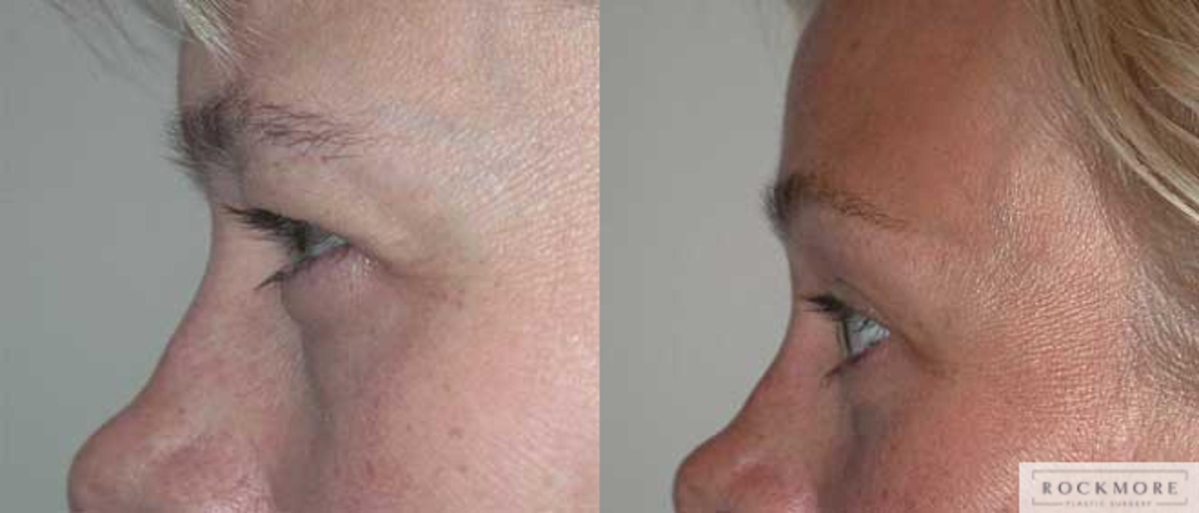 Before & After Eyelid Surgery Case 53 View #3 View in Albany & Latham, New York