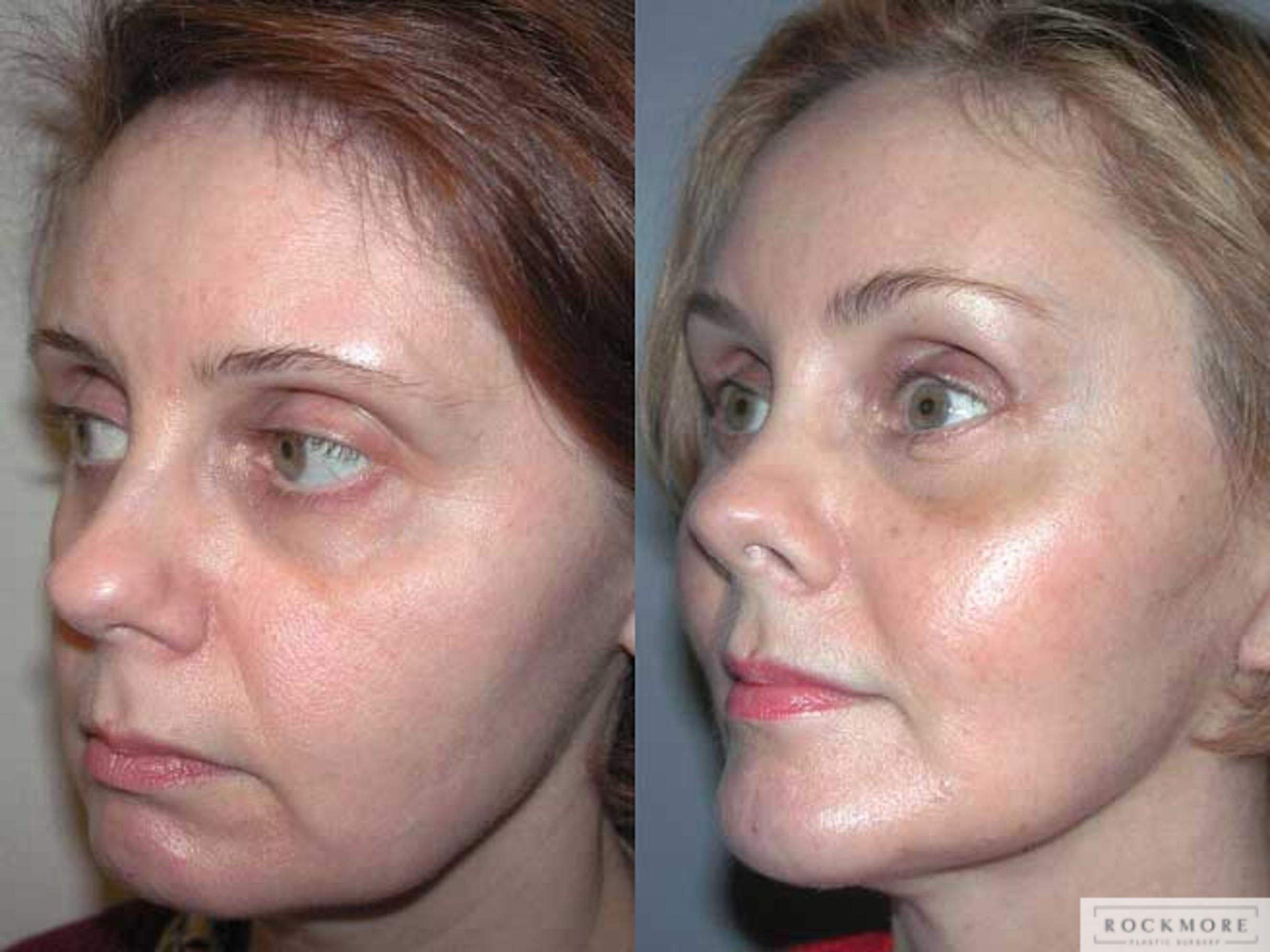 Before & After Facelift Case 1 View #2 View in Albany & Latham, New York