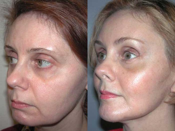 Before & After Facelift Case 1 View #2 View in Albany, Latham & Saratoga, New York