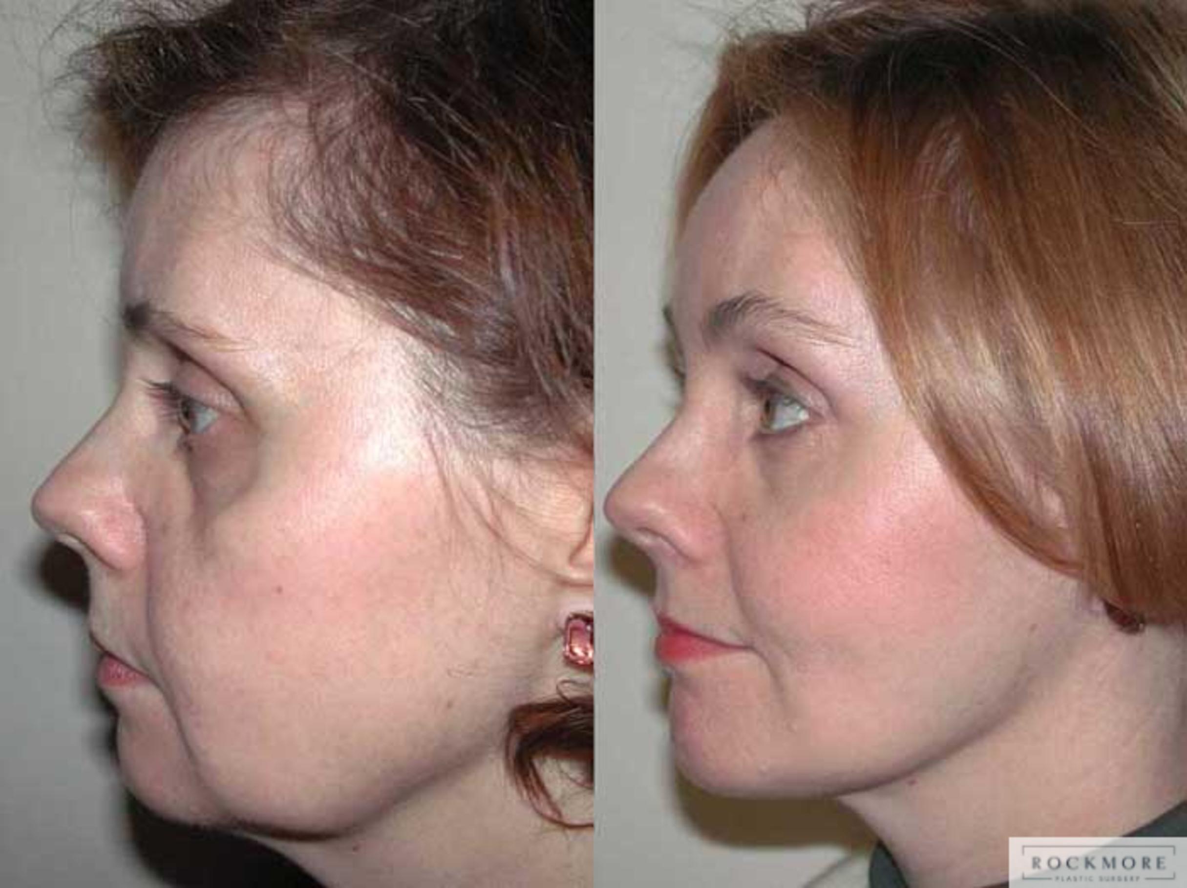 Before & After Facelift Case 1 View #3 View in Albany & Latham, New York