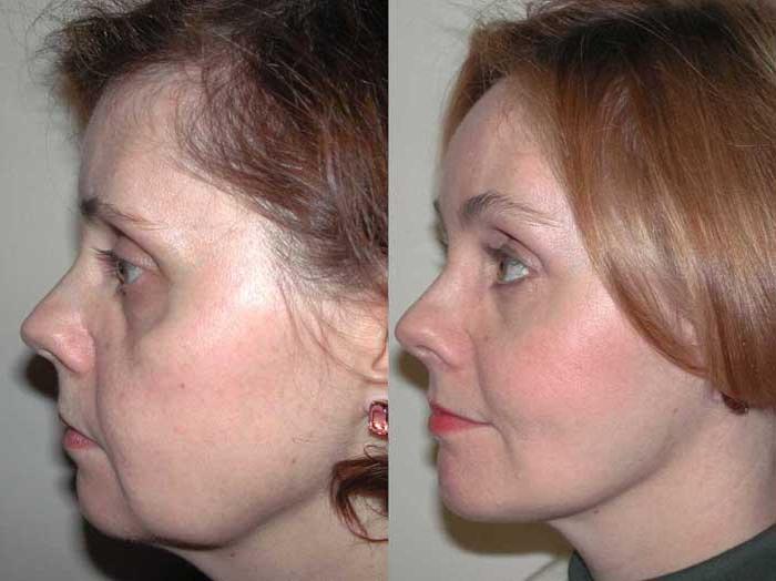 Before & After Facelift Case 1 View #3 View in Albany, Latham & Saratoga, New York