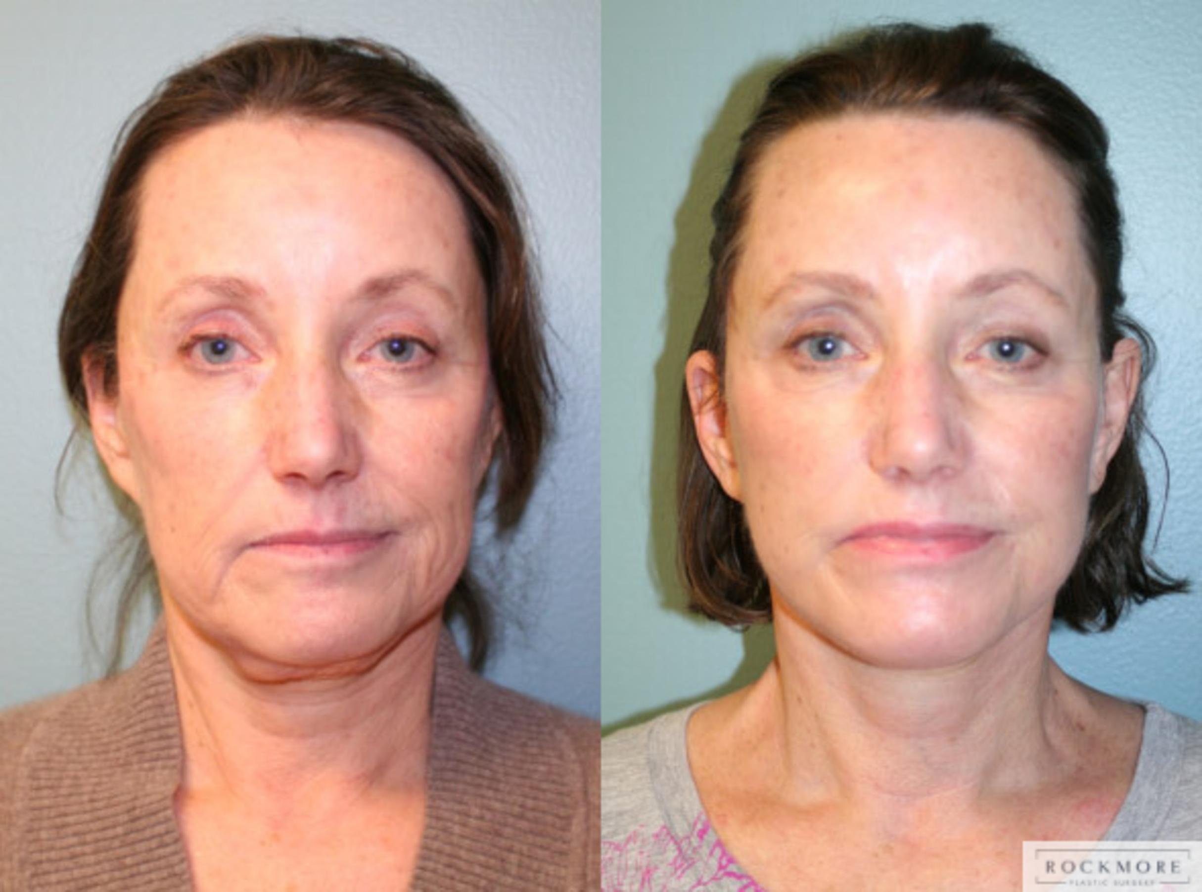 Before & After Facelift Case 149 View #1 View in Albany & Latham, New York