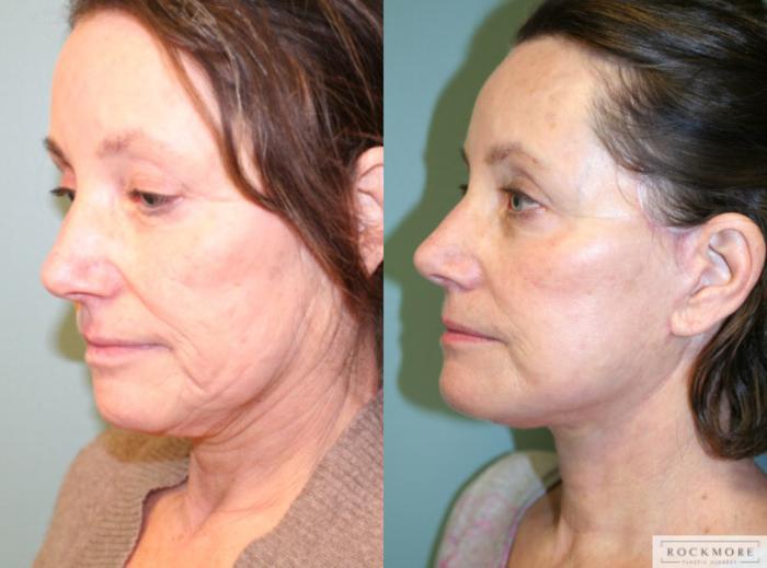 Before & After Facelift Case 149 View #2 View in Albany & Latham, New York