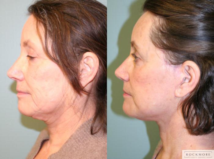 Before & After Facelift Case 149 View #3 View in Albany & Latham, New York