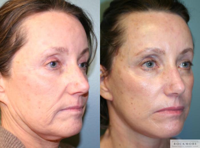 Before & After Facelift Case 149 View #4 View in Albany & Latham, New York