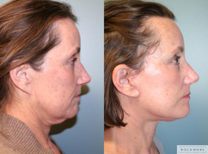 Before & After Facelift Case 149 View #5 View in Albany & Latham, New York