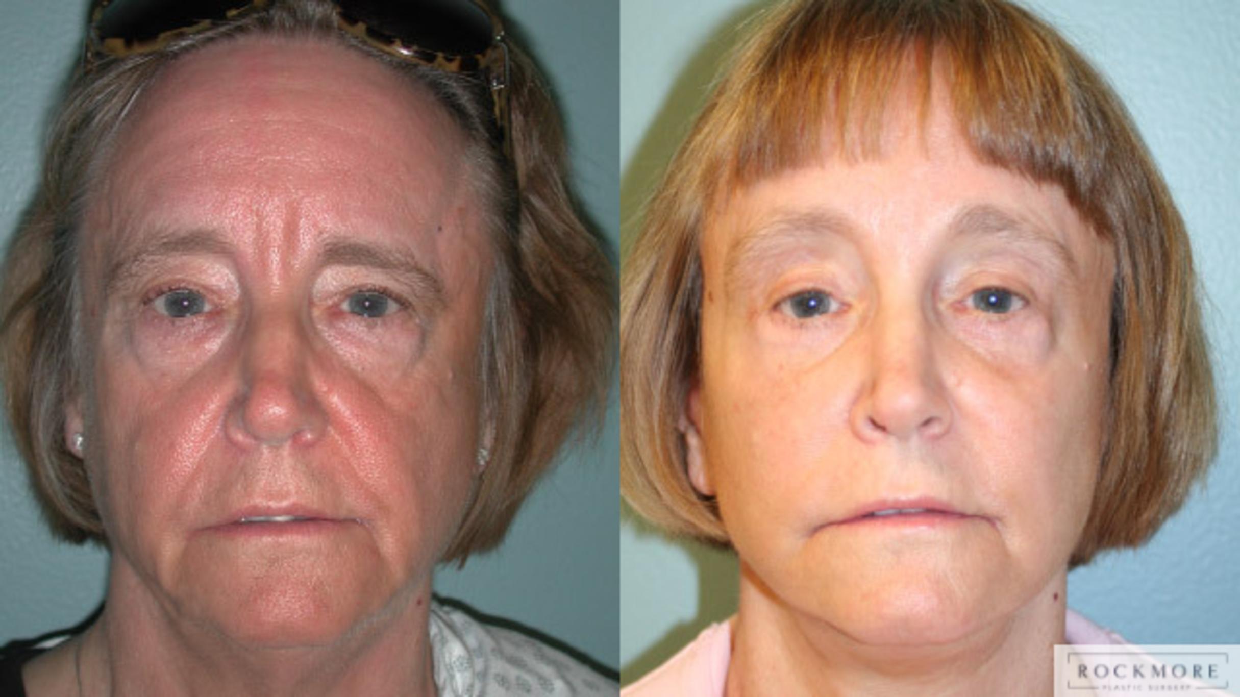 Before & After Facelift Case 153 View #1 View in Albany & Latham, New York