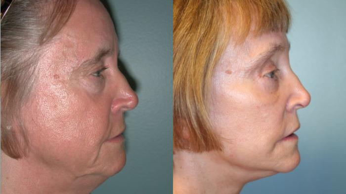 Before & After Facelift Case 153 View #3 View in Albany, Latham & Saratoga, New York