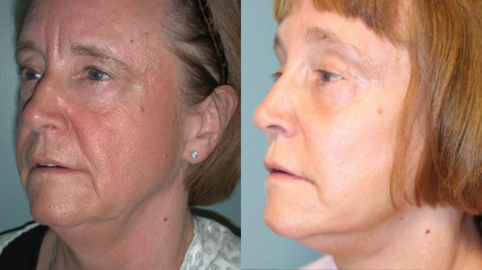 Before & After Facelift Case 153 View #4 View in Albany, Latham & Saratoga, New York