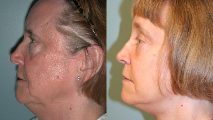 Before & After Facelift Case 153 View #5 View in Albany, Latham & Saratoga, New York