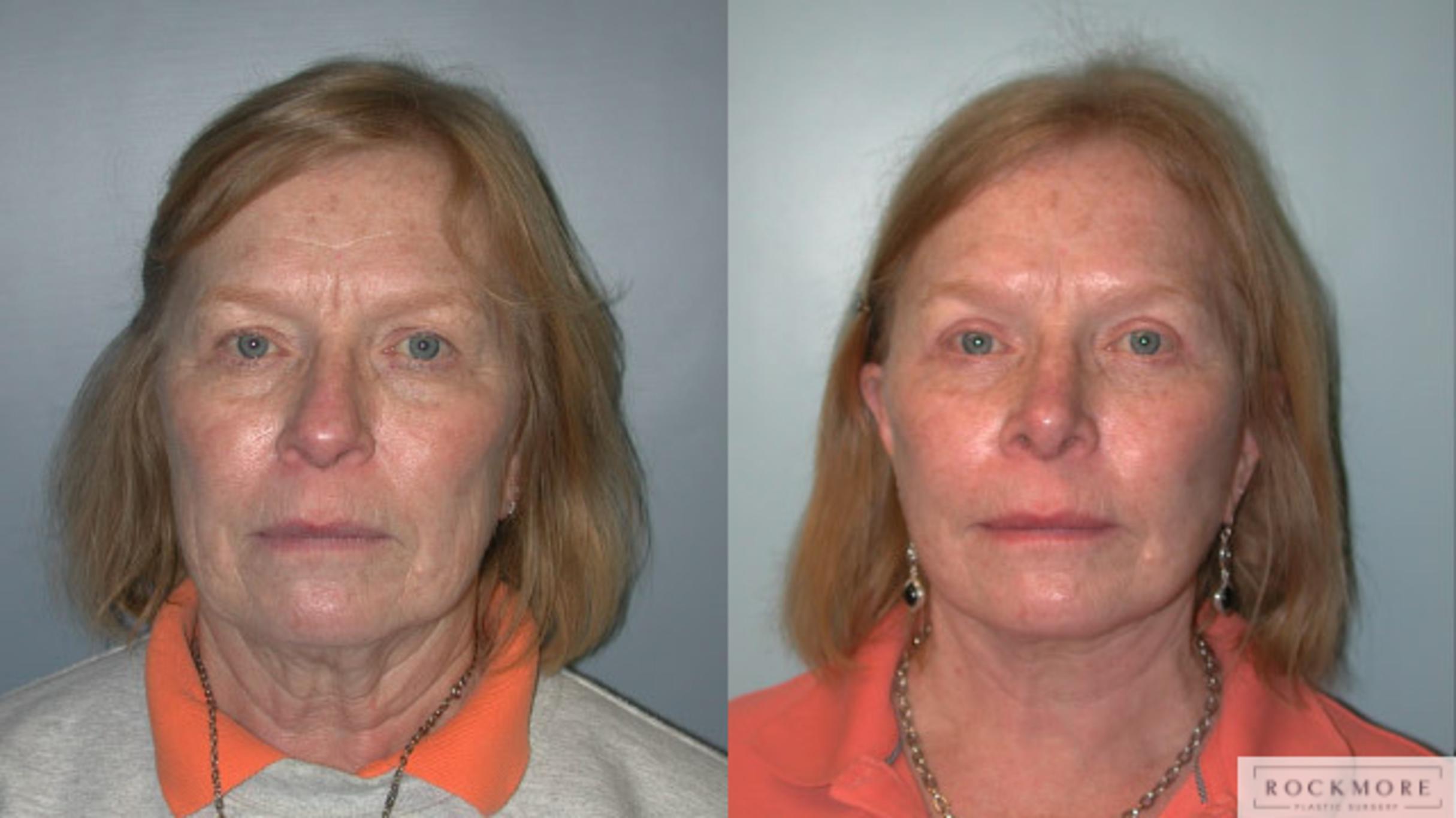 Before & After Facelift Case 154 View #1 View in Albany & Latham, New York