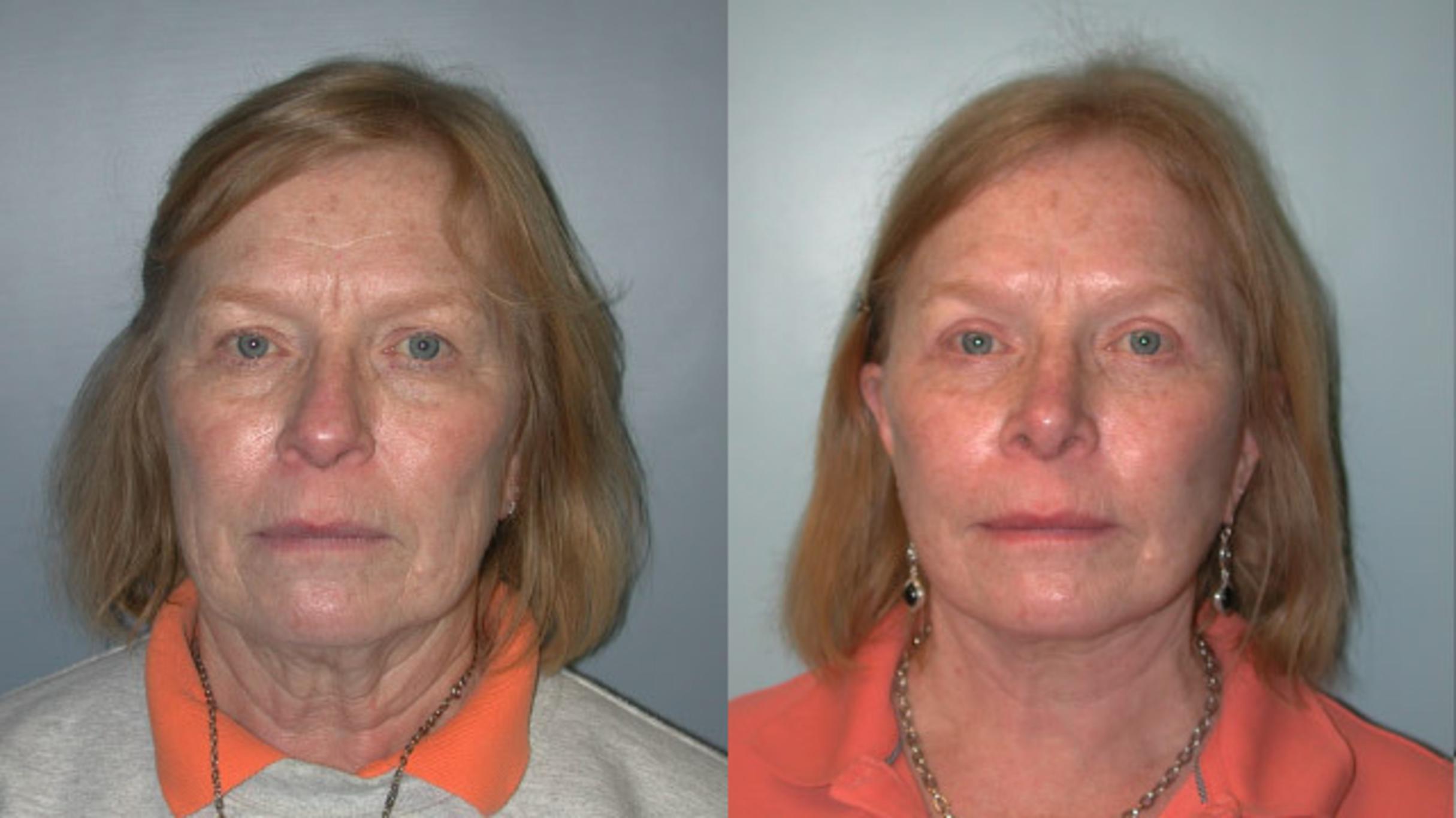 Before & After Facelift Case 154 View #1 View in Albany & Latham, New York