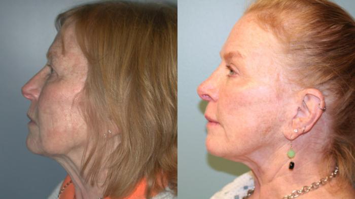 Before & After Facelift Case 154 View #3 View in Albany, Latham & Saratoga, New York