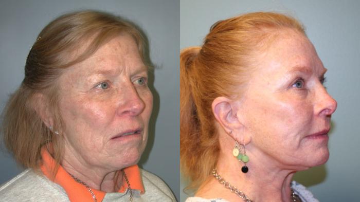 Before & After Facelift Case 154 View #4 View in Albany, Latham & Saratoga, New York