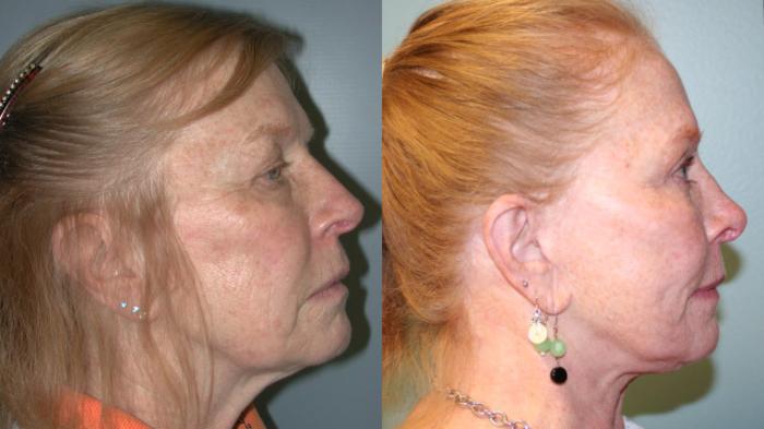 Before & After Facelift Case 154 View #5 View in Albany, Latham & Saratoga, New York