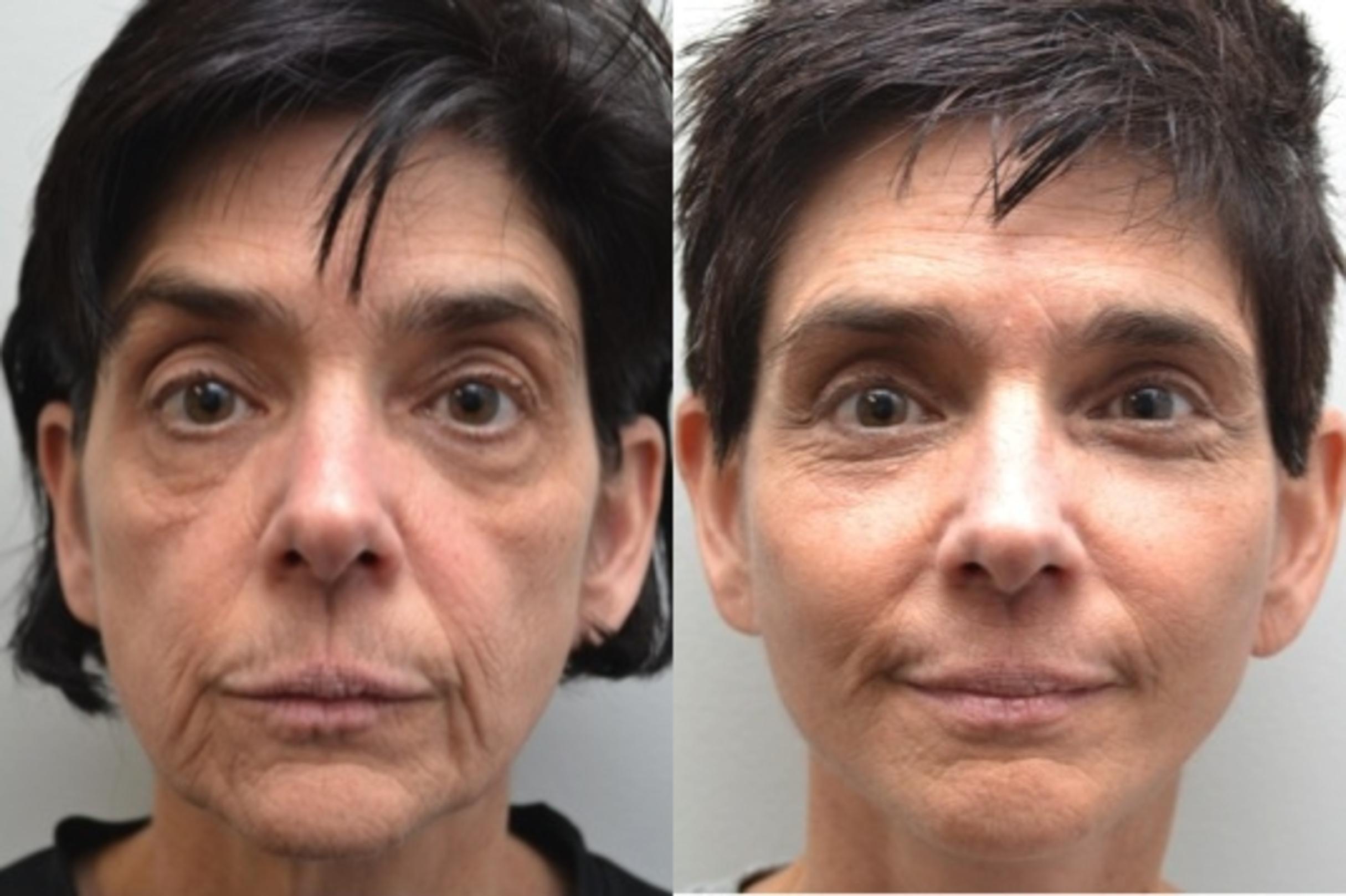 Before & After Eyelid Surgery Case 211 View #1 View in Albany & Latham, New York