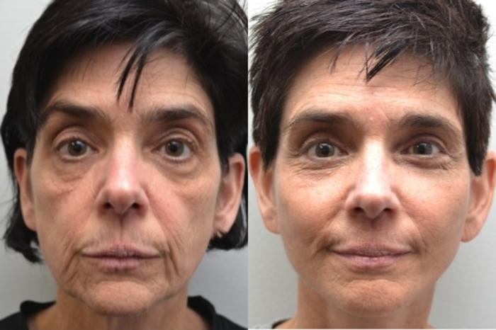 Before & After Eyelid Surgery Case 211 View #1 View in Albany, Latham & Saratoga, New York