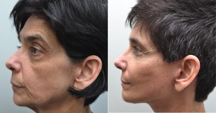 Before & After Eyelid Surgery Case 211 View #3 View in Albany, Latham & Saratoga, New York