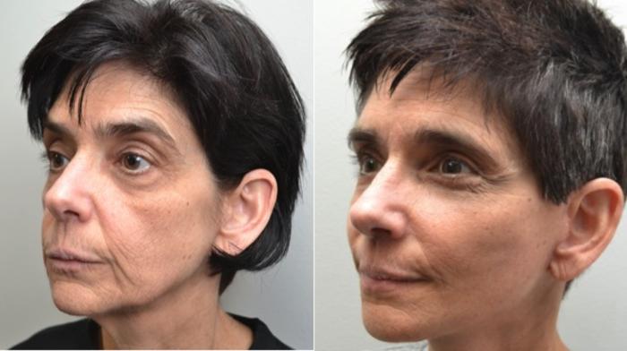 Before & After Eyelid Surgery Case 211 View #4 View in Albany, Latham & Saratoga, New York