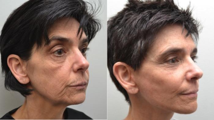 Before & After Eyelid Surgery Case 211 View #5 View in Albany, Latham & Saratoga, New York