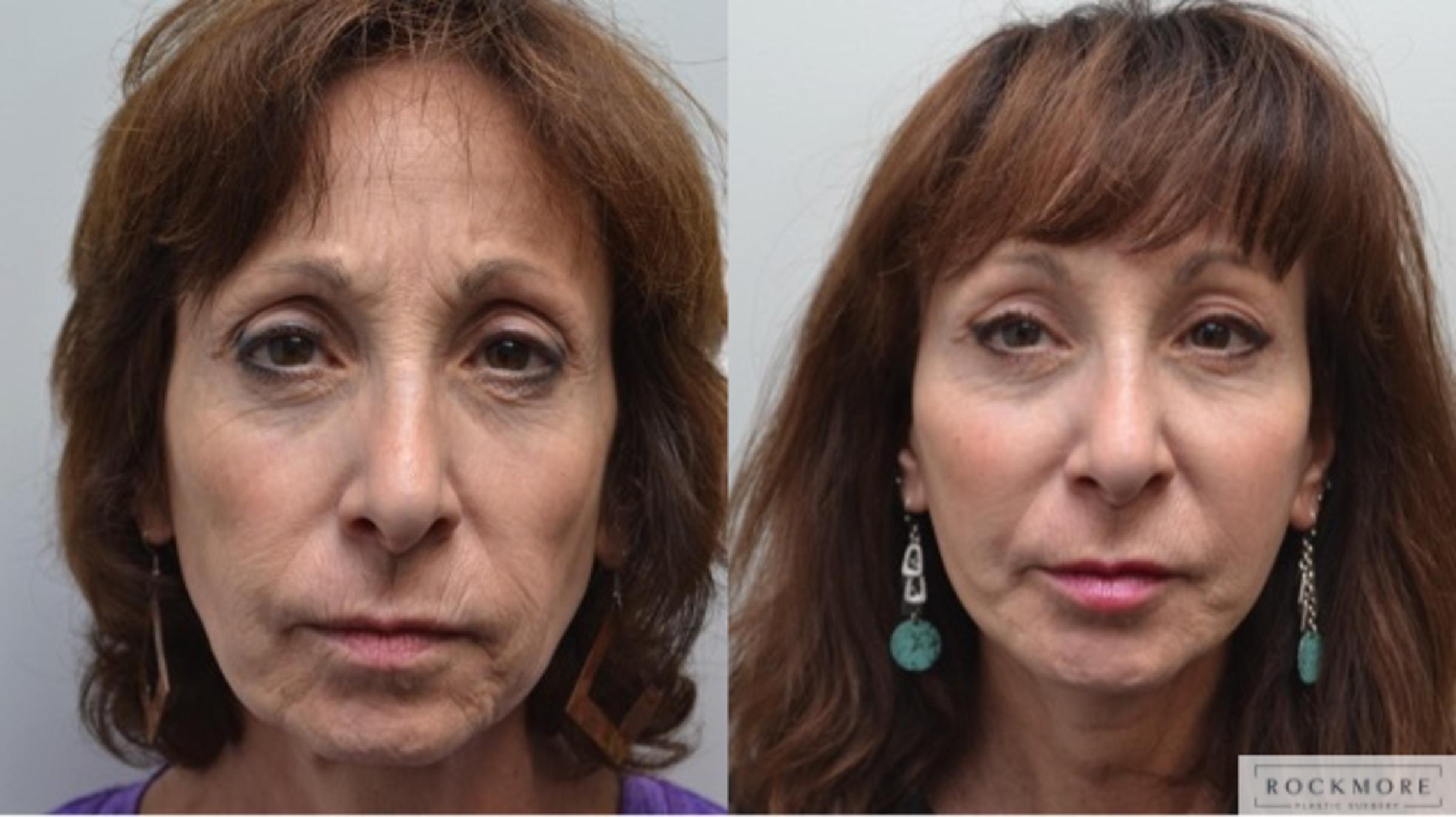 Before & After Facelift Case 240 View #1 View in Albany & Latham, New York