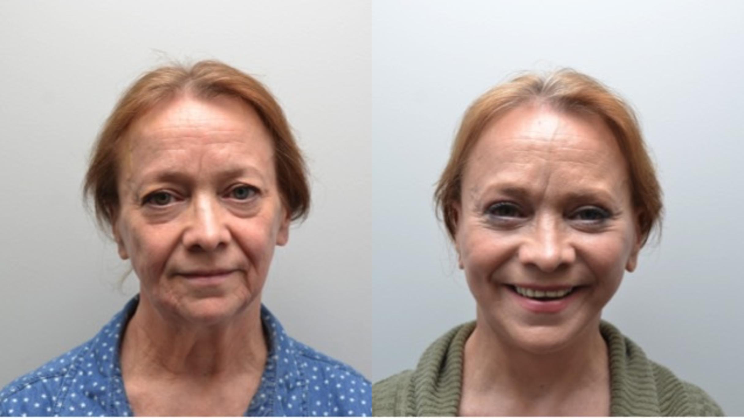 Before & After Eyelid Surgery Case 267 View #1 View in Albany, Latham & Saratoga, New York