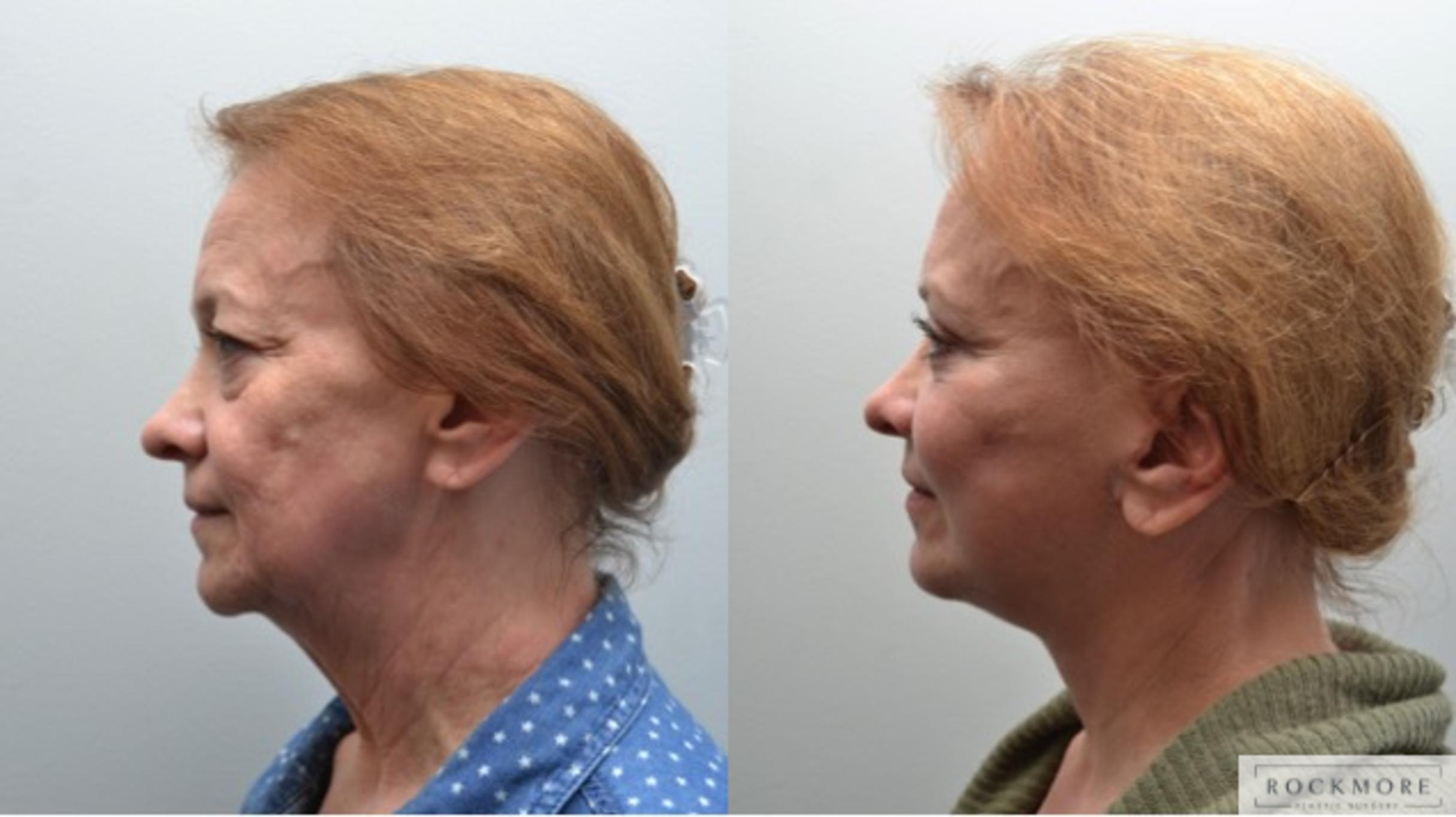 Before & After Facelift Case 267 View #2 View in Albany & Latham, New York