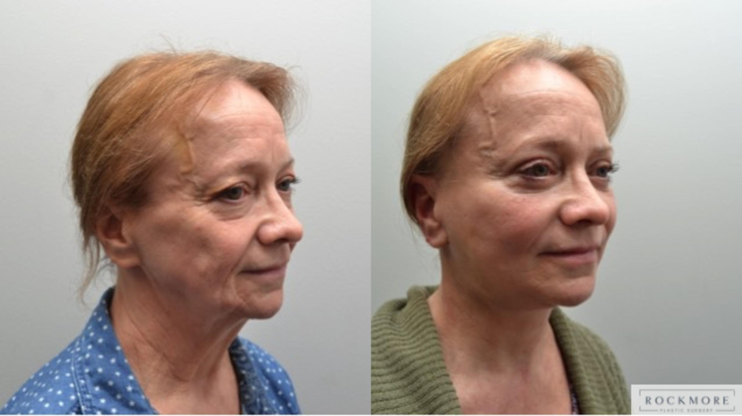 Before & After Facelift Case 267 View #4 View in Albany & Latham, New York