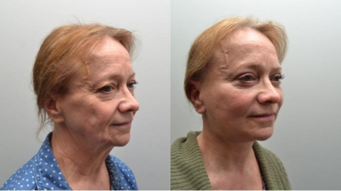 Before & After Facelift Case 267 View #4 View in Albany, Latham & Saratoga, New York