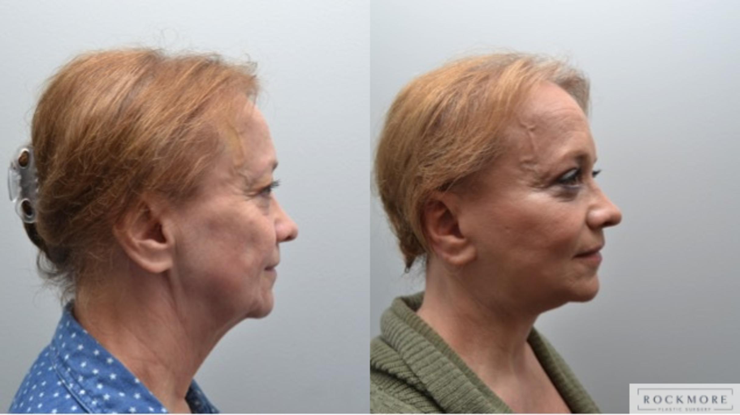 Before & After Facelift Case 267 View #5 View in Albany & Latham, New York