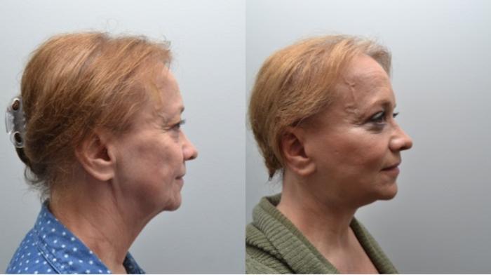 Before & After Facelift Case 267 View #5 View in Albany, Latham & Saratoga, New York