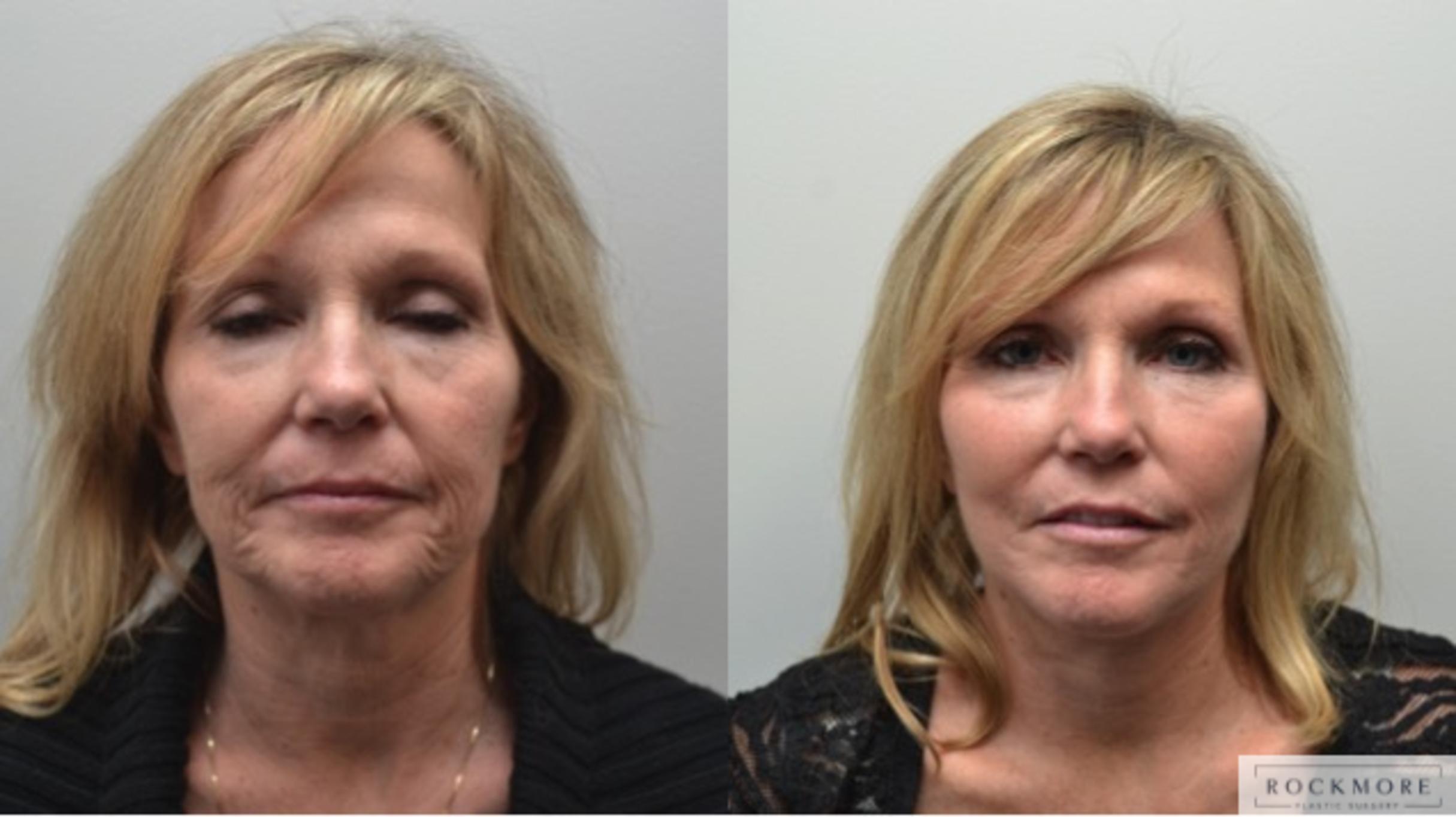 Before & After Facelift Case 277 View #1 View in Albany & Latham, New York
