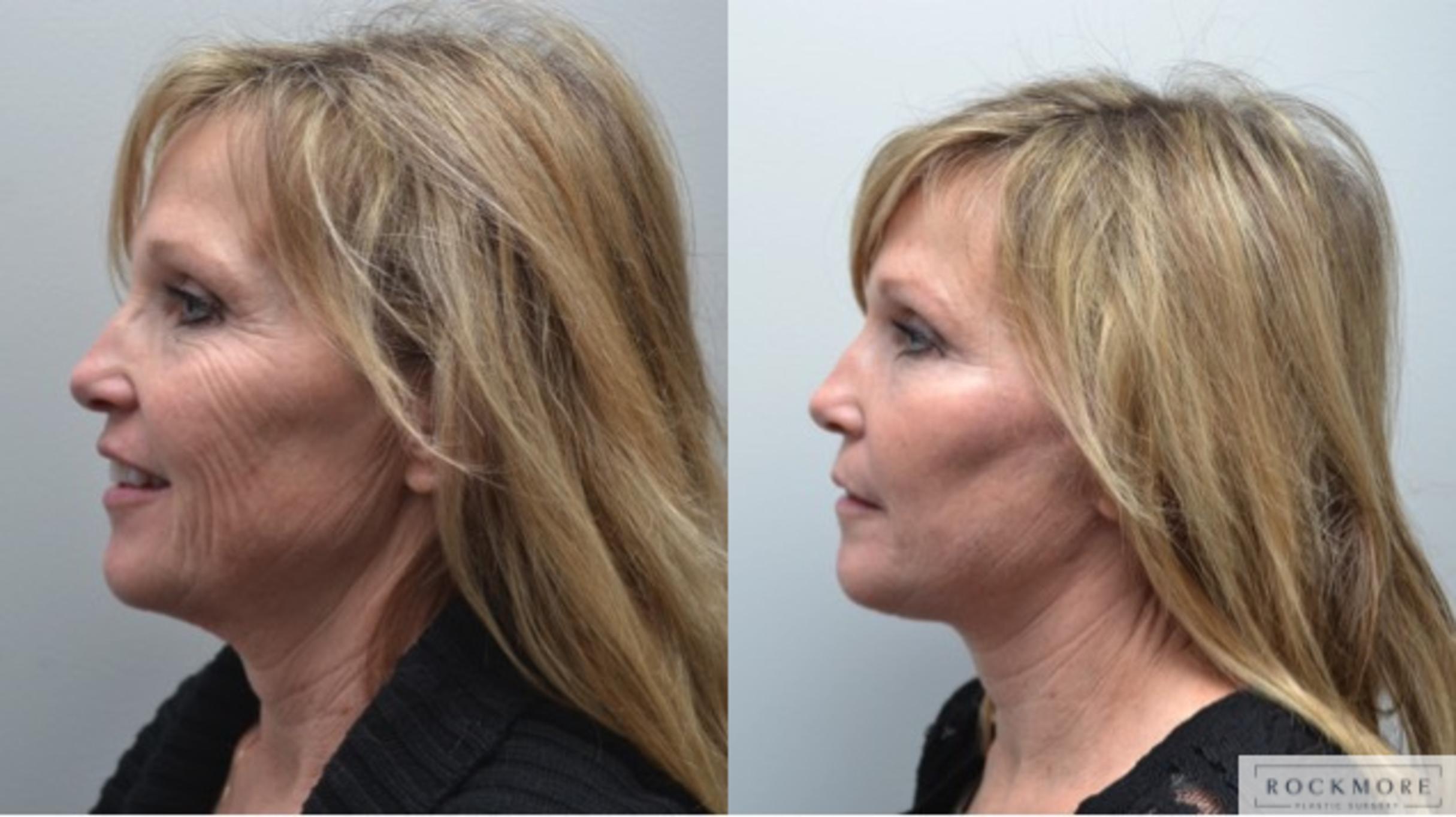 Before & After Facelift Case 277 View #2 View in Albany & Latham, New York