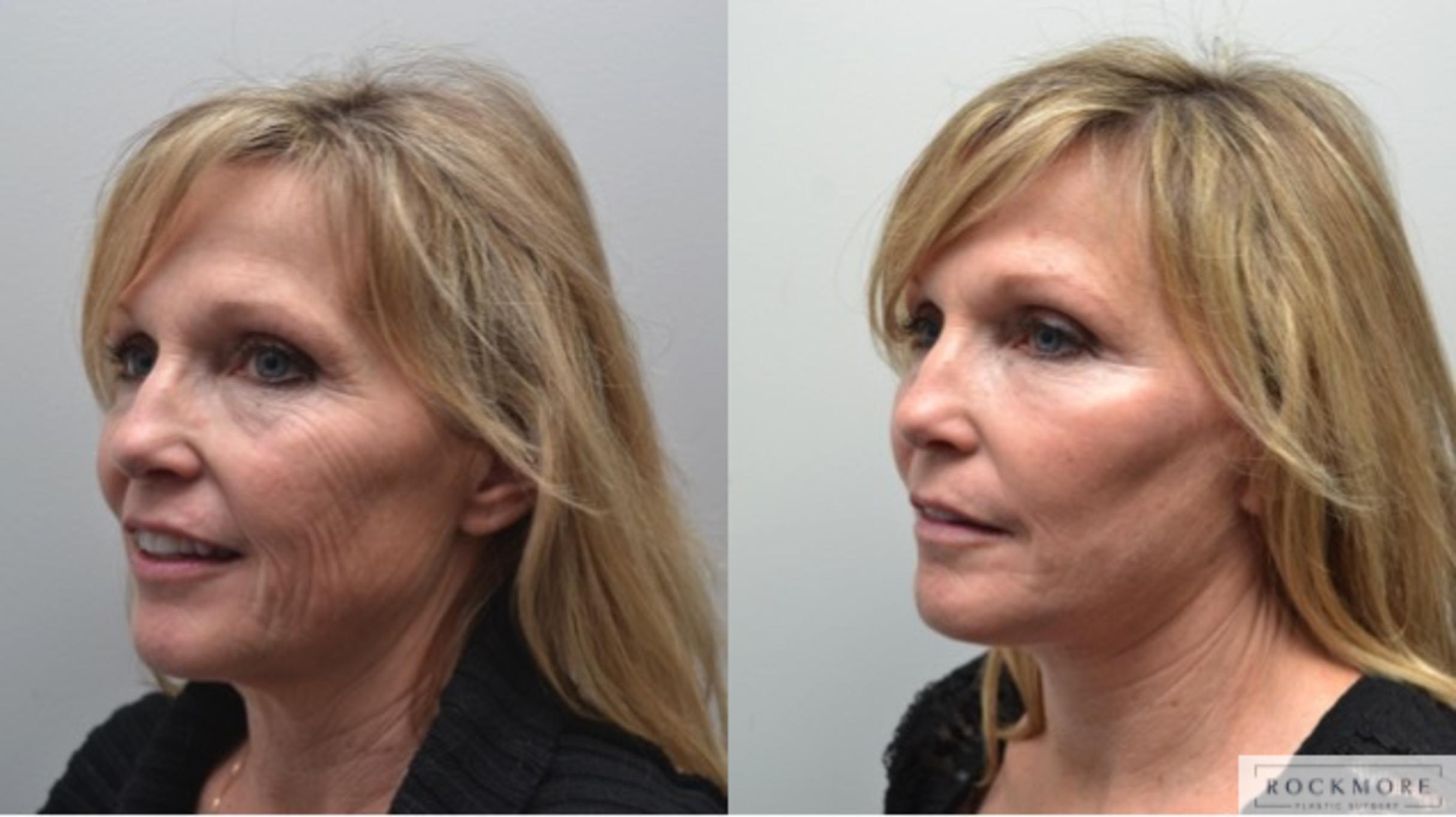 Before & After Facelift Case 277 View #3 View in Albany & Latham, New York