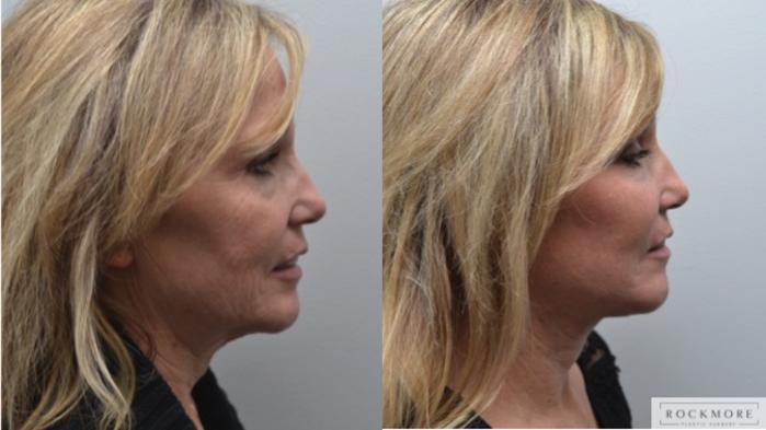 Before & After Facelift Case 277 View #4 View in Albany & Latham, New York