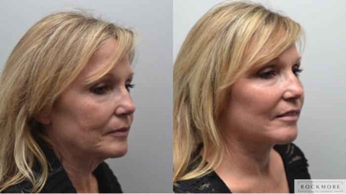 Before & After Facelift Case 277 View #5 View in Albany & Latham, New York