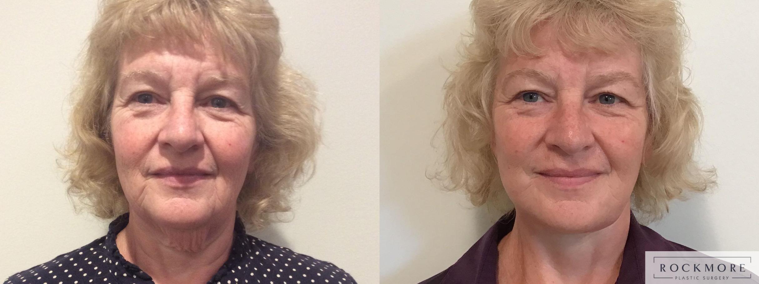 Before & After Facelift Case 335 Front View in Albany & Latham, New York