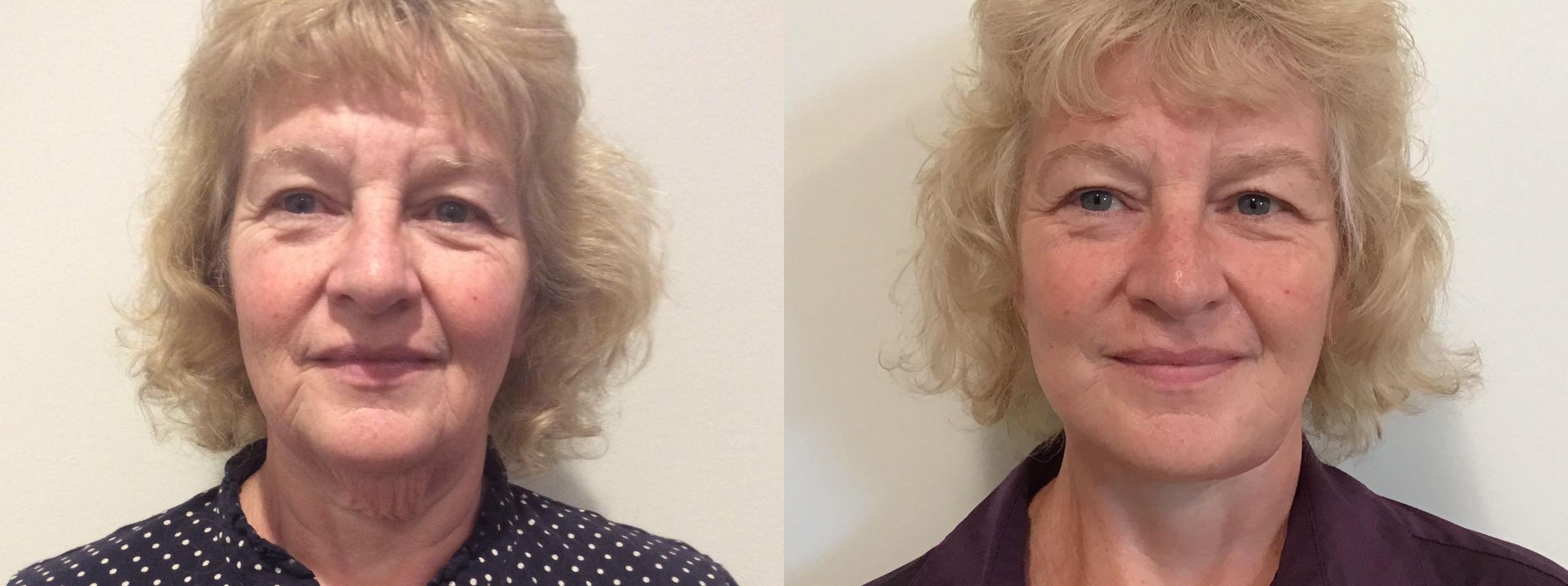 Before & After Facelift Case 335 Front View in Albany & Latham, New York