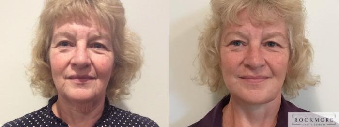 Before & After Neck Lift Case 335 Front View in Albany & Latham, New York