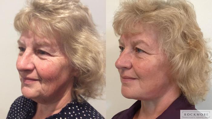 Before & After Facelift Case 335 Left Oblique View in Albany & Latham, New York