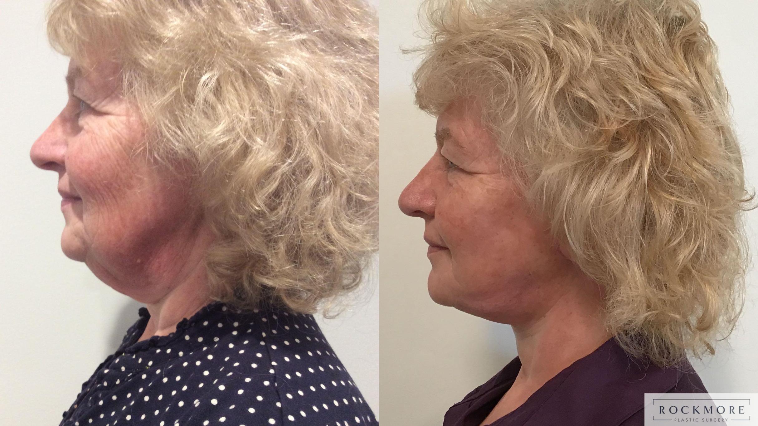 Before & After Neck Lift Case 335 Left Side View in Albany & Latham, New York