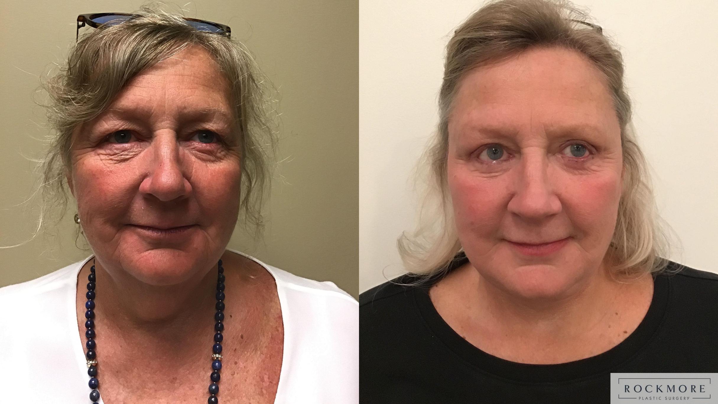 Before & After Neck Lift Case 337 Front View in Albany & Latham, New York