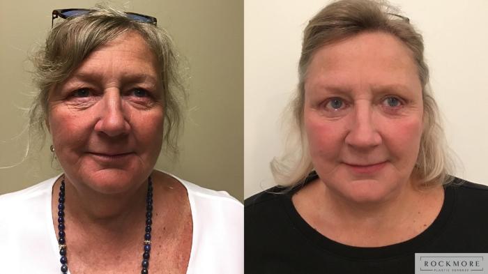 Before & After Facelift Case 337 Front View in Albany & Latham, New York