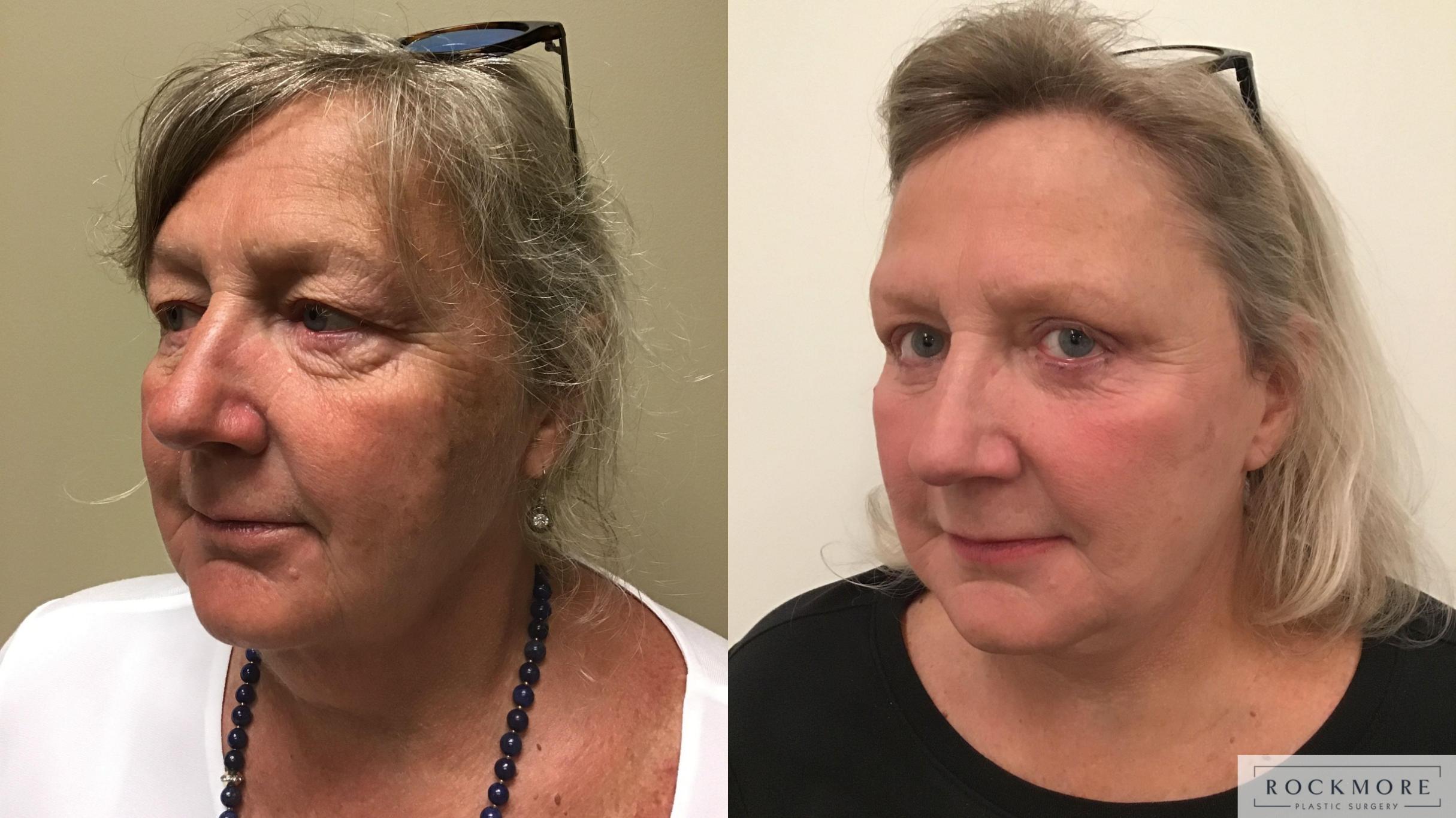 Before & After Eyelid Surgery Case 337 Left Oblique View in Albany & Latham, New York