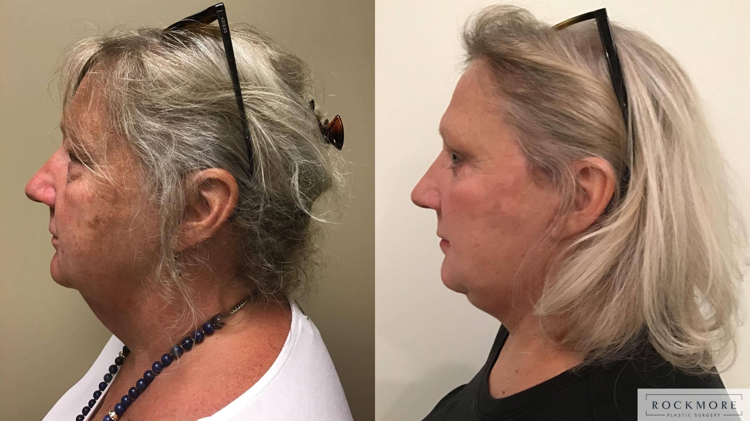 Before & After Facelift Case 337 Left Side View in Albany & Latham, New York