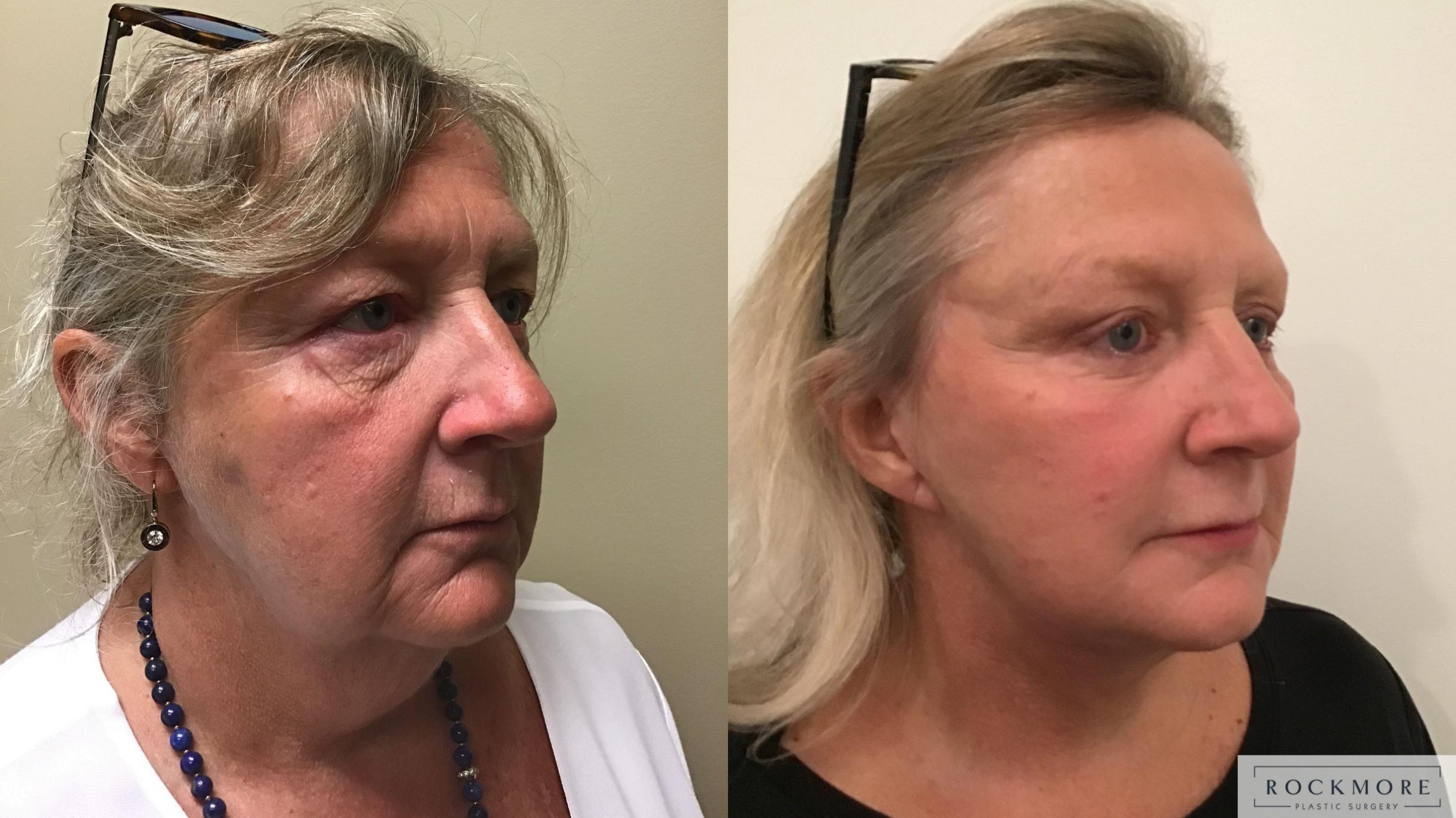 Before & After Neck Lift Case 337 Right Oblique View in Albany & Latham, New York