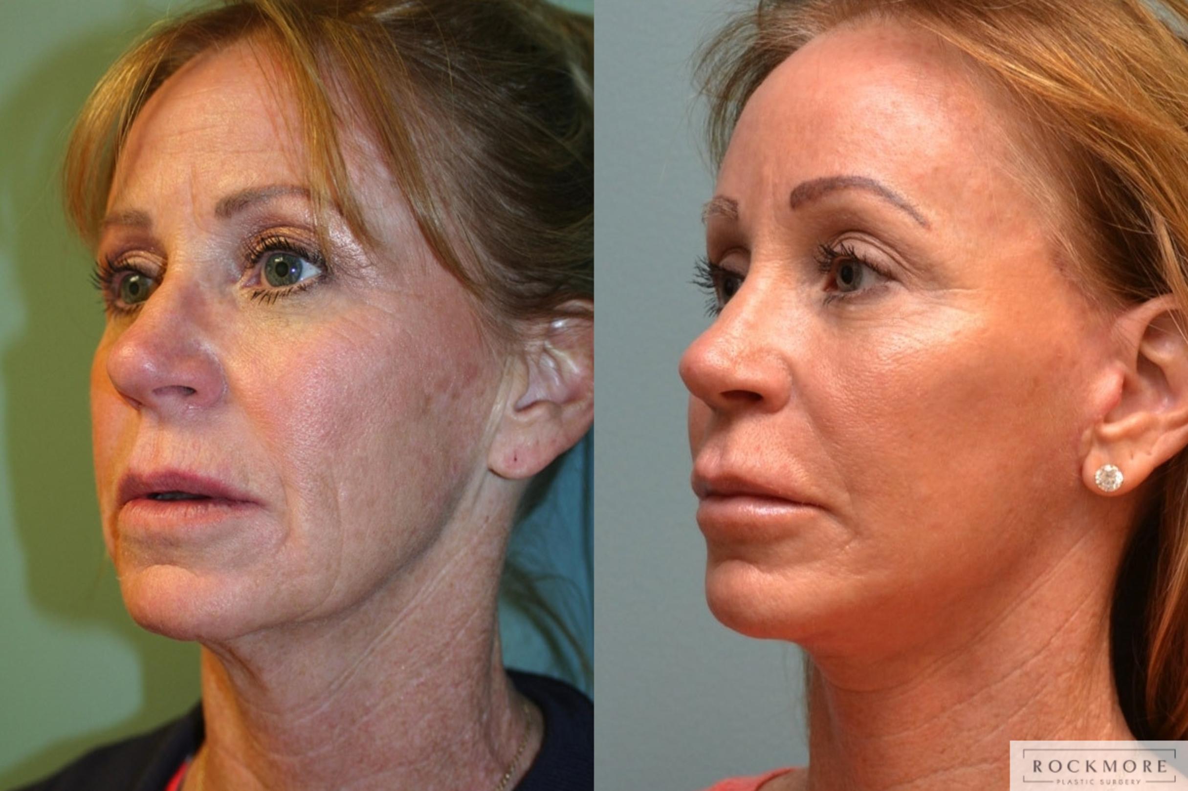 Before & After Neck Lift Case 347 Left Oblique View in Albany & Latham, New York