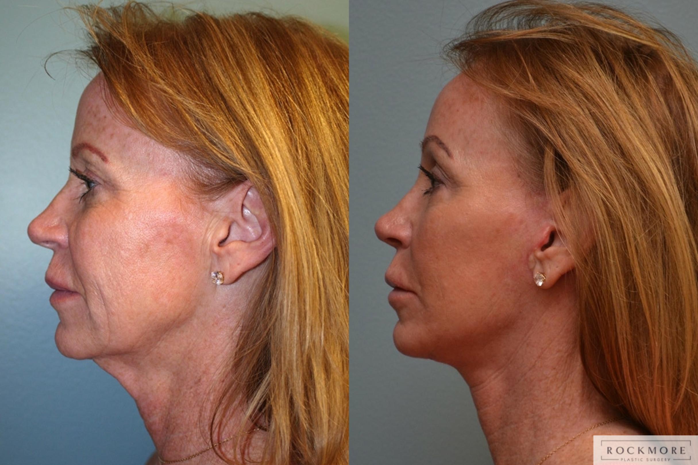 Before & After Neck Lift Case 347 Left Side View in Albany & Latham, New York