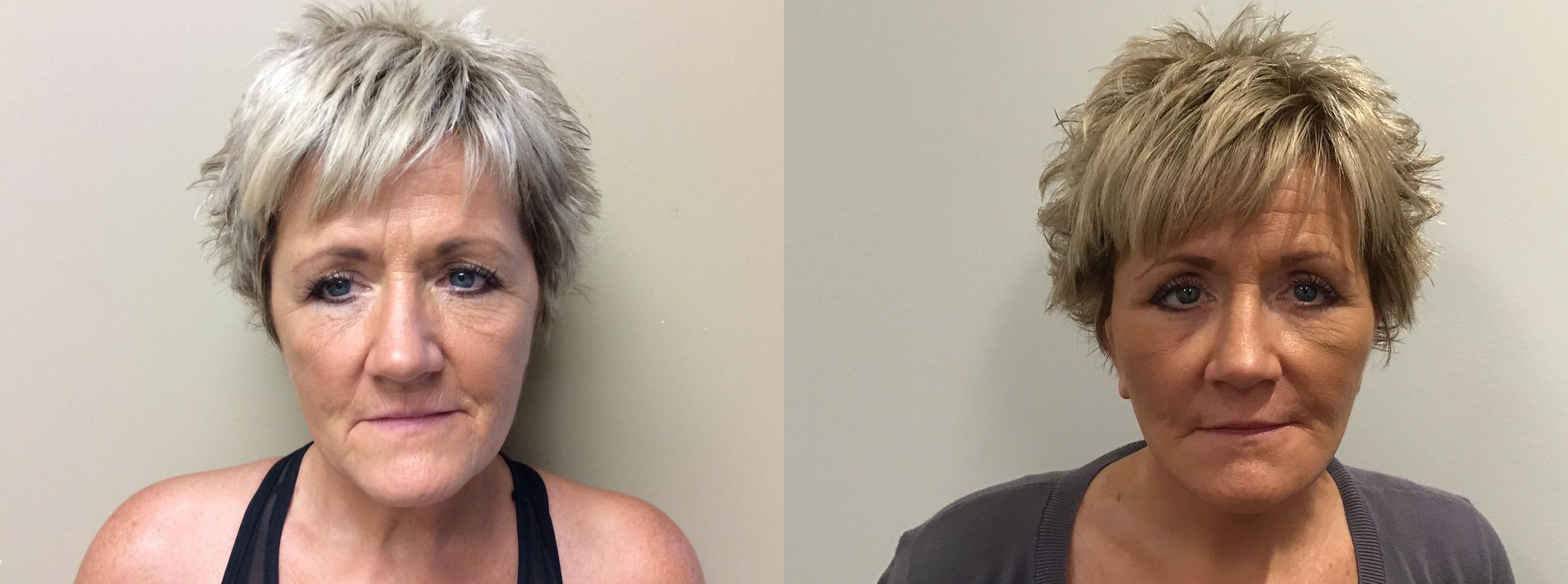 Before & After Neck Lift Case 378 Front View in Albany, Latham & Saratoga, New York